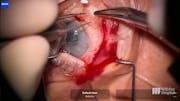 Hypotony Challenge: Choroidal Effusion Drainage and Compression Suture