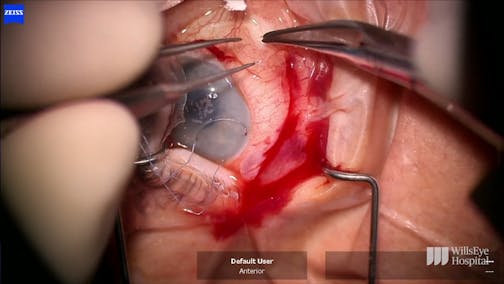 Hypotony Challenge: Choroidal Effusion Drainage and Compression Suture