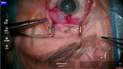 Susvimo: Surgical Pearls & Tricks #4 (Conjunctival closure)