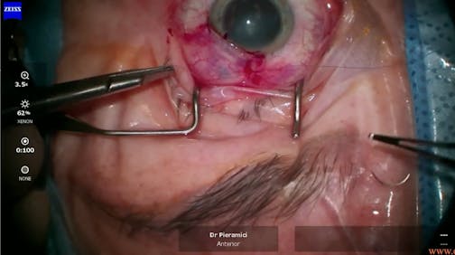 Susvimo: Surgical Pearls & Tricks #4 (Conjunctival closure)