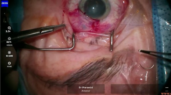 Susvimo: Surgical Pearls & Tricks #4 (Conjunctival closure) thumbnail