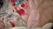 Susvimo: Surgical Pearls - Pars Plana Incision, Implant Insertion