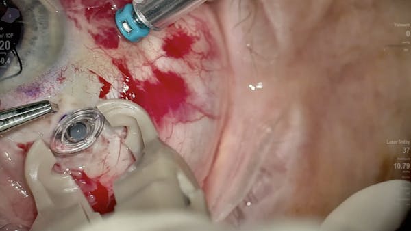 Susvimo: Surgical Pearls - Pars Plana Incision, Implant Insertion thumbnail