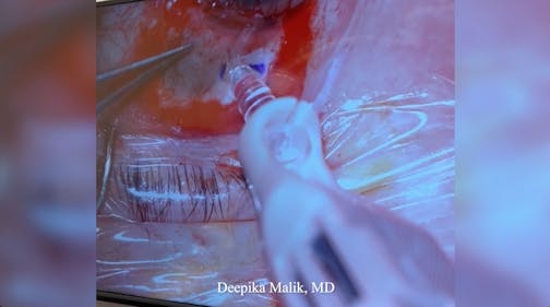 Susvimo: Surgical Pearls & Tricks #3