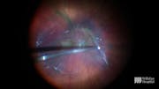 Complex Membrane Peel in Case of Combined Hamartoma