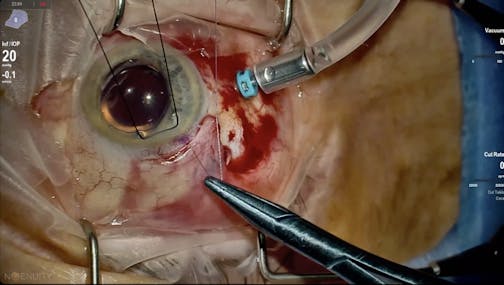 Susvimo: Surgical Pearls - Conjunctival Closure & Final Comments