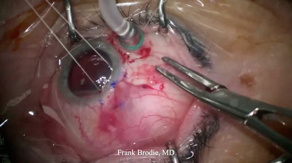 Susvimo: Surgical Pearls & Tricks #4 thumbnail