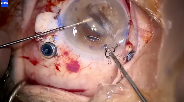 Dislocated IOL thumbnail