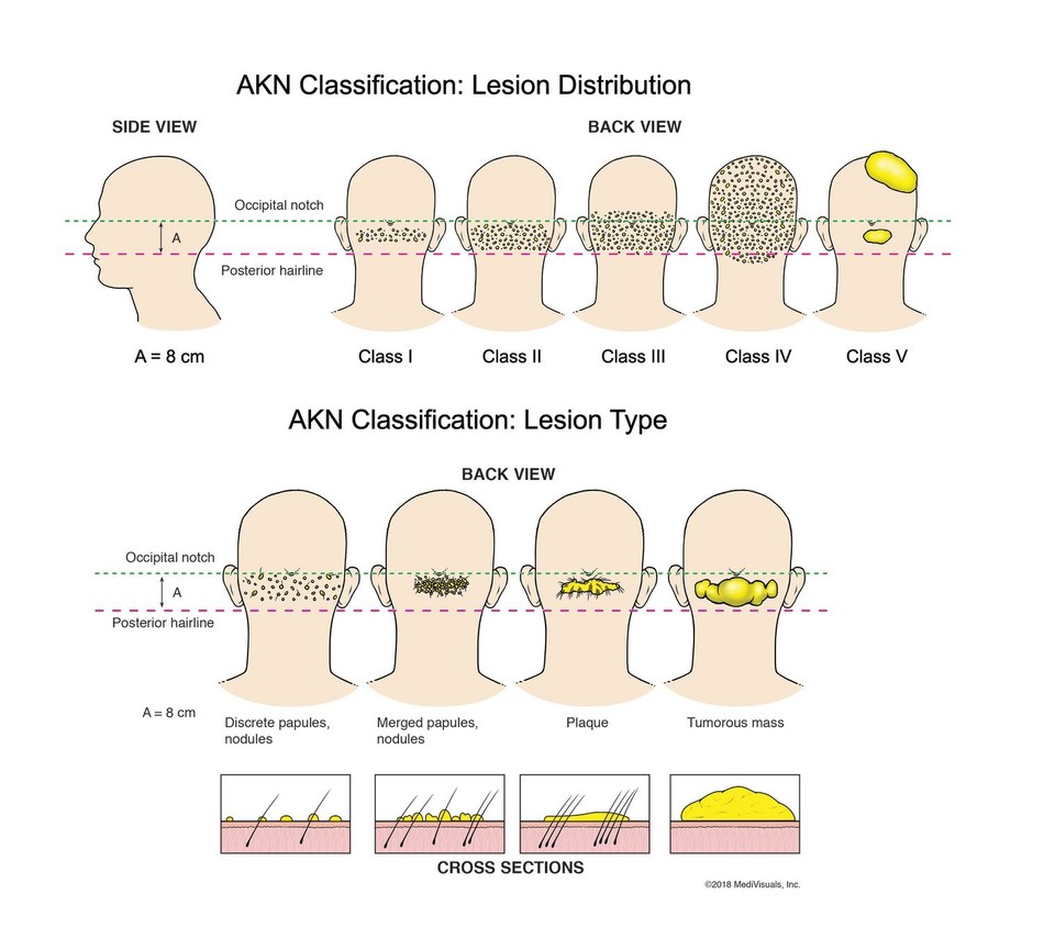 New AKN Classification System May Improve Treatment - Practical