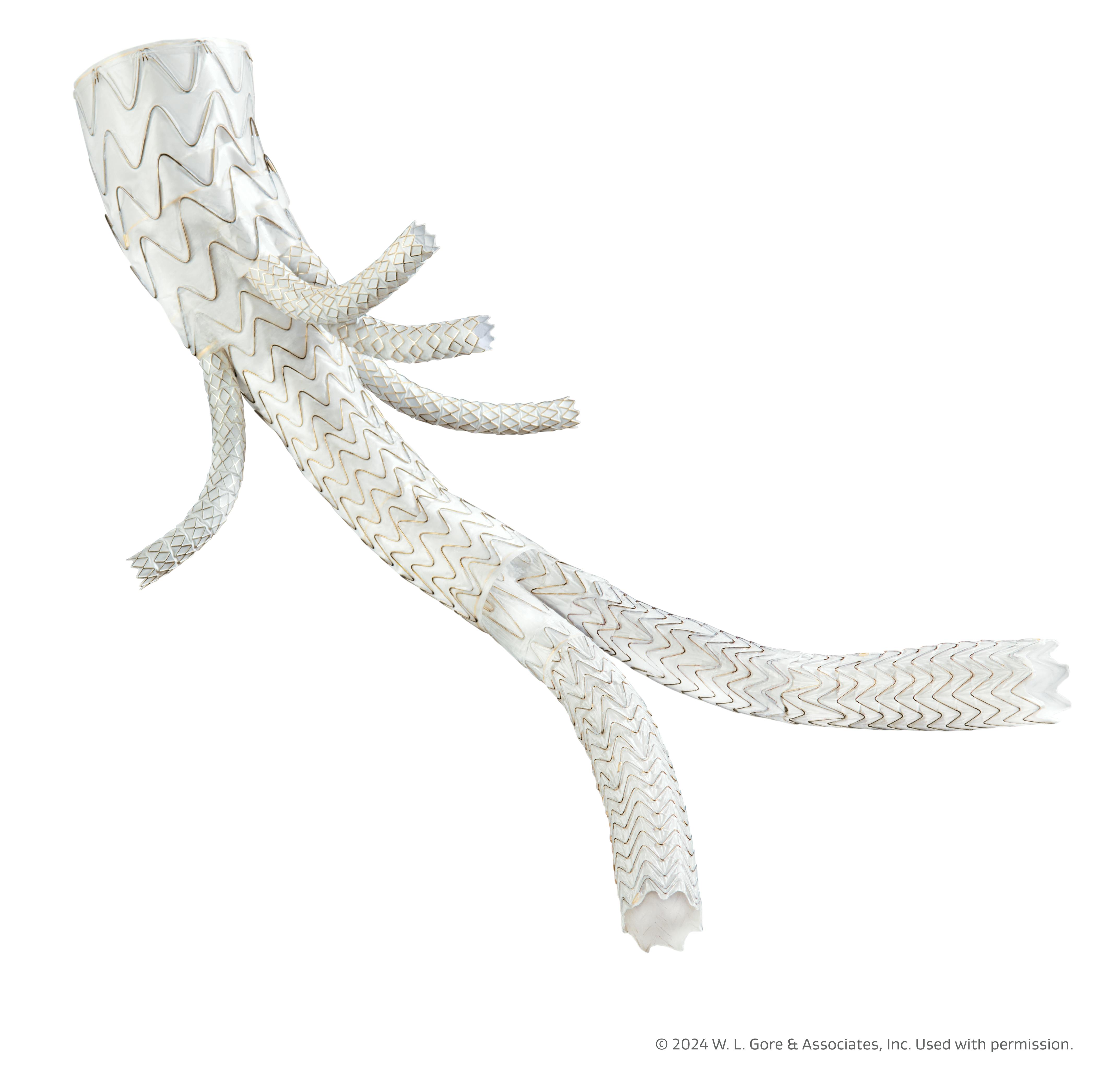 Gore s Excluder TAMBE Approved By FDA To Treat Complex Aortic Aneurysms gore-s-excluder-tambe-approved-by-fda-to-treat-complex-aortic-aneurysms