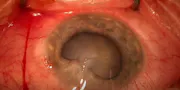 Management of Penetrating Ocular Trauma