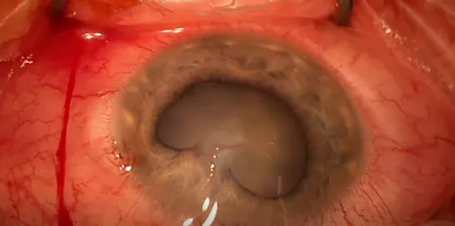 Management of Penetrating Ocular Trauma