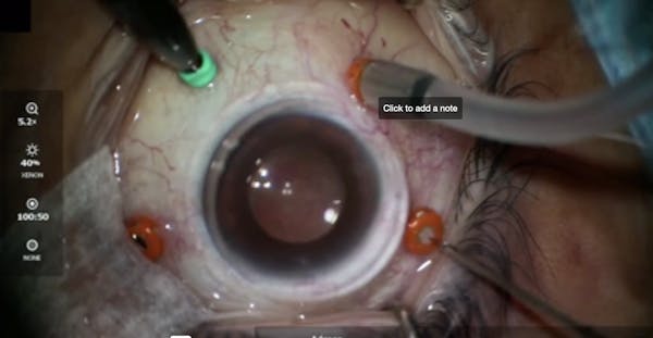 Macular Hole With Amniotic Membrane Graft thumbnail