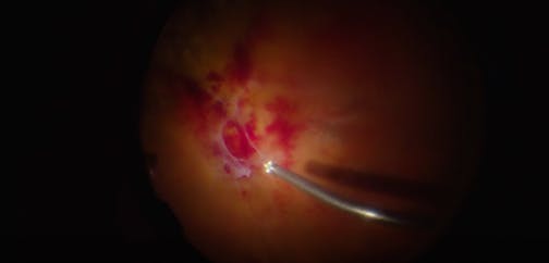 Proliferative Diabetic Retinopathy With 3D Visualization