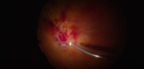 Proliferative Diabetic Retinopathy With 3D Visualization thumbnail