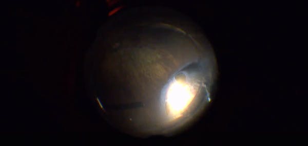Twelve Harmless Retinal Tears thumbnail