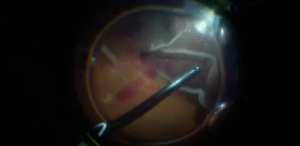 Hemorrhagic Choroidals Following Retinal Detachment Repair thumbnail