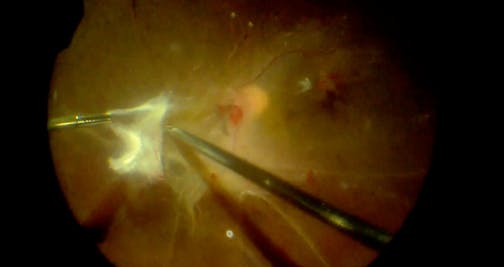 Peeling of Broad Diabetic Membranes