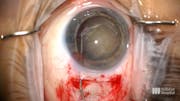 Management of Brunescent Cataract With SICS