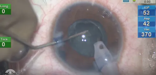 Phakic IOL Explantation and Phacoemulsification With Toric IOL Implantation