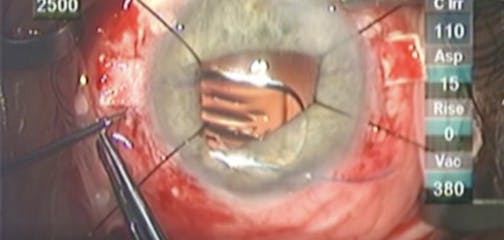 Glued Scleral IOL Fixation