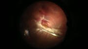 Vitrectomy for Diabetic Tractional Retinal Detachment