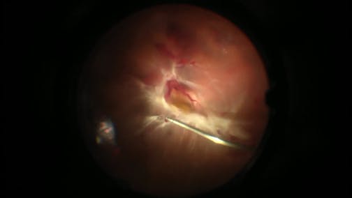 Vitrectomy for Diabetic Tractional Retinal Detachment