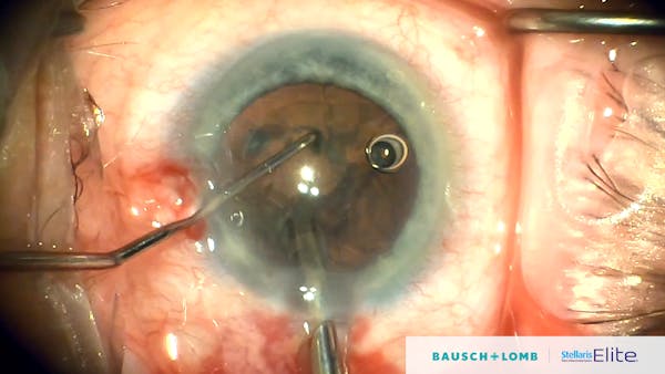 Manage All Cataract Densities With the Stellaris Elite System thumbnail