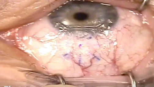 Treatment of Posterior Flap for Persistent Rainbow Glare After LASIK