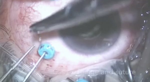 Chronic Macular Hole Repair With Autologous Blood thumbnail