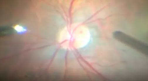 Vitrectomy for CRAO: Ocular Angioplasty