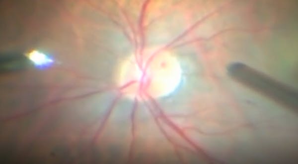 Vitrectomy for CRAO: Ocular Angioplasty thumbnail