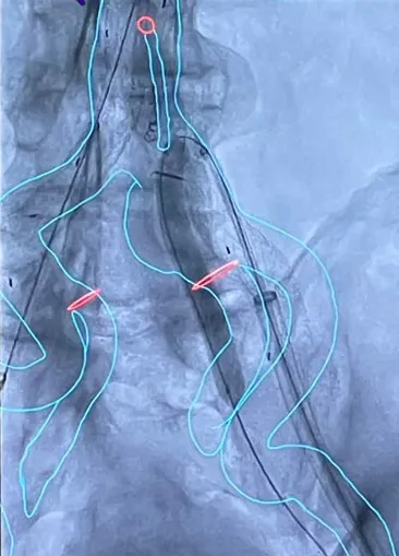 First Patient Treated in Medtronic Aortic-Cydar AI Collaboration - Vimarsana News