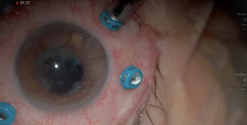 Retained Lens Fragments and Lens Fixation With the Yamane Technique