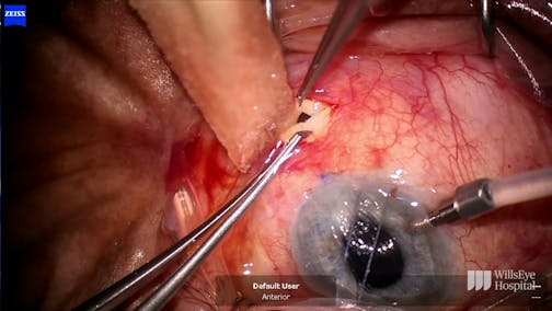 Bleb Revision and Management of Choroidal Effusions