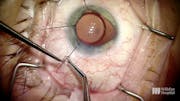 Operating on a Worsening Cataract With Coloboma