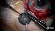 IOL Exchange and Iris Prosthesis