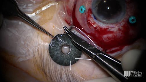 IOL Exchange and Iris Prosthesis