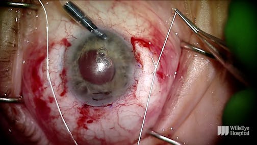 IOL Exchange After Multiple Postoperative Complications