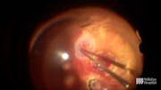 Autologous Retinal Transplant for a Full-Thickness Macular Hole
