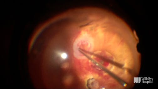 Autologous Retinal Transplant for a Full-Thickness Macular Hole