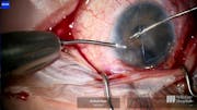 Tube Exchange in Uncontrolled Glaucoma
