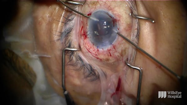 IOL Fixation With DSEK thumbnail