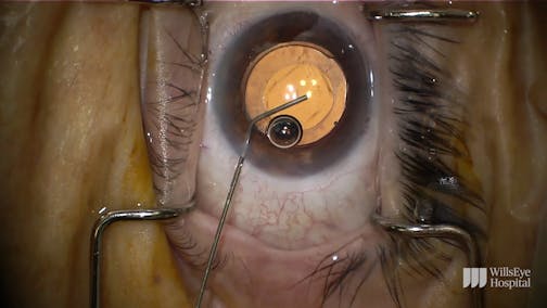IOL Exchange Following Cataract Surgery