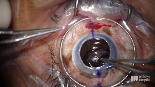 Penetrating Keratoplasty and IOL Exchange