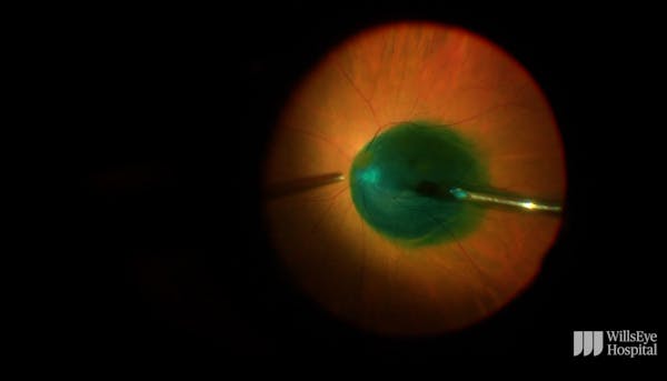 Guidance on Repairing a Macular Hole thumbnail