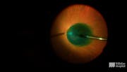 Guidance on Repairing a Macular Hole