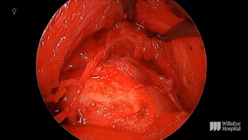 Corneal Neurotization for Neurotrophic Keratitis