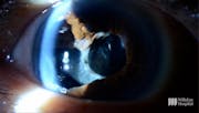 Iris Repair Following Complicated Cataract Surgery