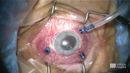 Subfoveal PFO Removal With Soft-Tip Cannula